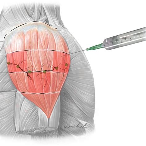 paula siongco|Botulinum neurotoxin injections for muscle.